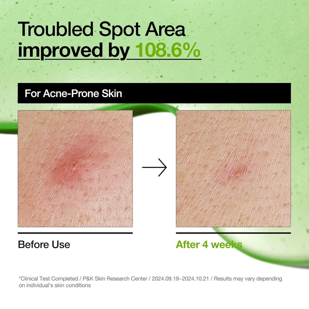 Anua 10+ Azelaic Acid Hyaluron Soothing Serum (30mL) Survana