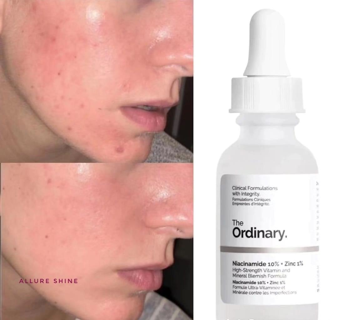 The Ordinary Niacinamide 10%+ Zinc 1% Serum 30mL - 100% Authentic