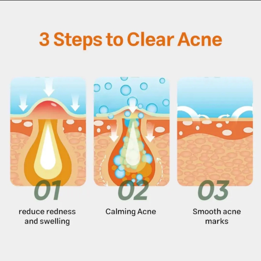 SURVANA Magic Acne* Corrector  Gel 20g (UK Formulated) Survana